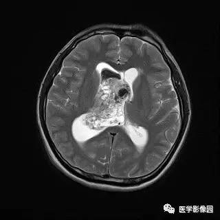 【病例】中枢神经细胞瘤1例MR影像表现 【病例】中枢神经细胞瘤1例MR影像表现