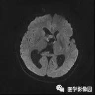 【病例】中枢神经细胞瘤1例MR影像表现 【病例】中枢神经细胞瘤1例MR影像表现