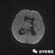 【病例】中枢神经细胞瘤1例MR影像表现 【病例】中枢神经细胞瘤1例MR影像表现