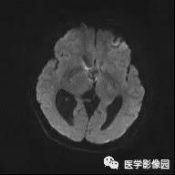 【病例】中枢神经细胞瘤1例MR影像表现 【病例】中枢神经细胞瘤1例MR影像表现