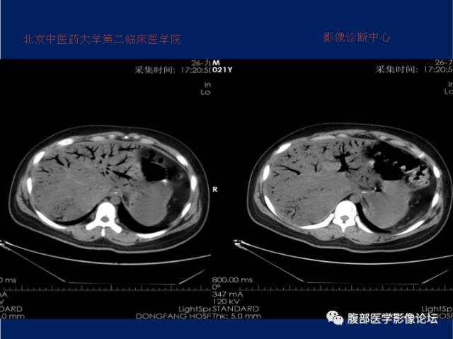 【病例】肝门静脉积气征1例CT影像表现