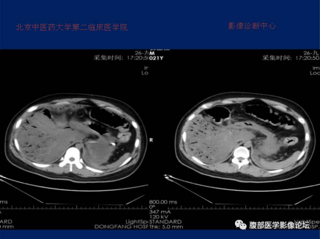 【病例】肝门静脉积气征1例CT影像表现 【病例】肝门静脉积气征1例CT影像表现