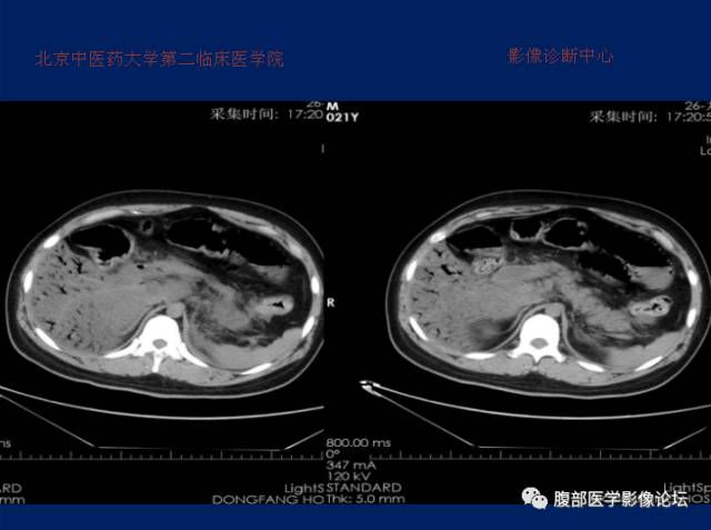 【病例】肝门静脉积气征1例CT影像表现 【病例】肝门静脉积气征1例CT影像表现