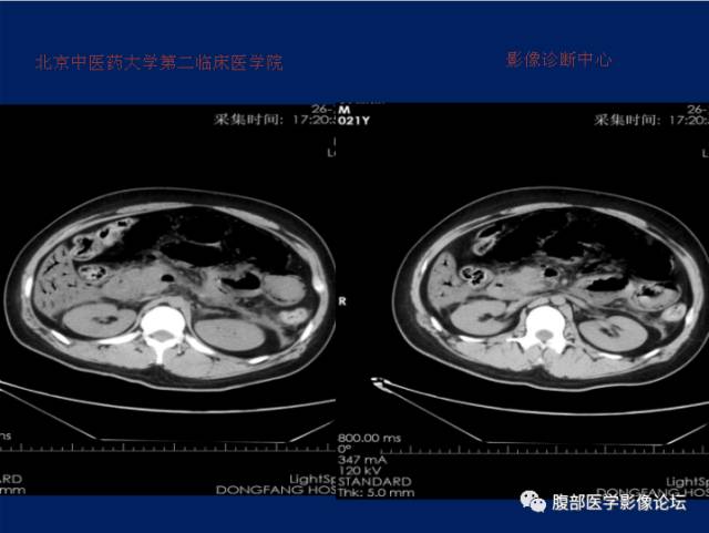 【病例】肝门静脉积气征1例CT影像表现 【病例】肝门静脉积气征1例CT影像表现