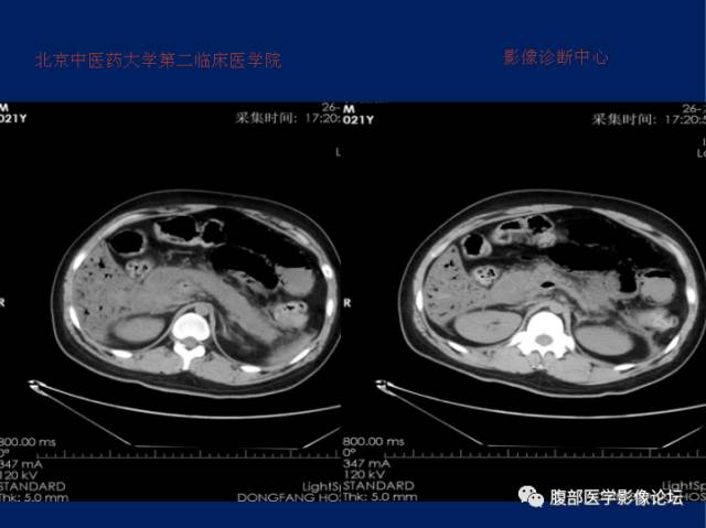 【病例】肝门静脉积气征1例CT影像表现 【病例】肝门静脉积气征1例CT影像表现