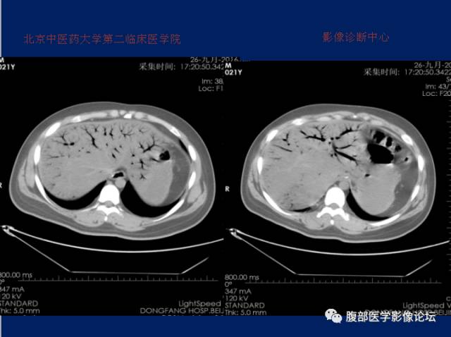 【病例】肝门静脉积气征1例CT影像表现 【病例】肝门静脉积气征1例CT影像表现