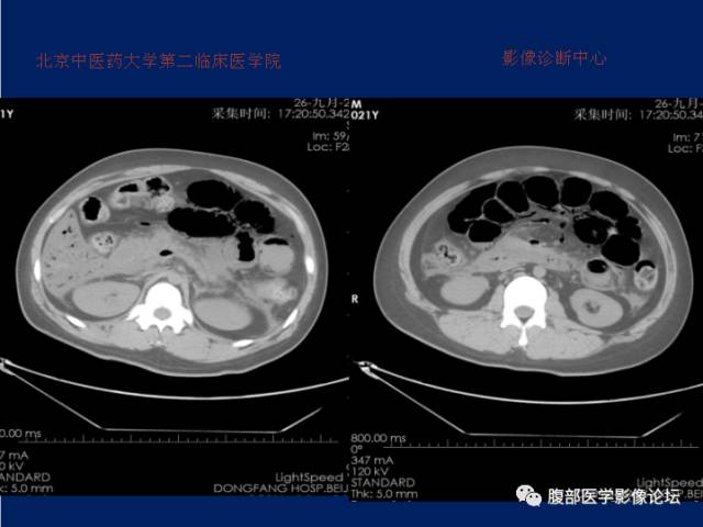 【病例】肝门静脉积气征1例CT影像表现 【病例】肝门静脉积气征1例CT影像表现