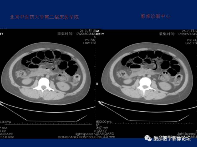 【病例】肝门静脉积气征1例CT影像表现 【病例】肝门静脉积气征1例CT影像表现