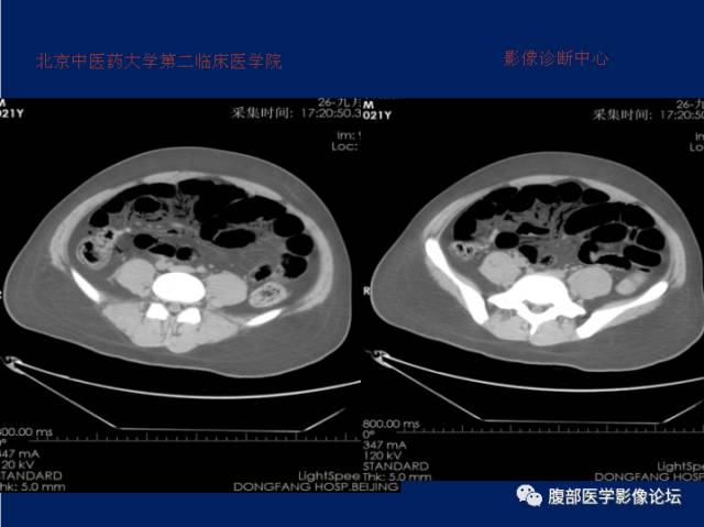 【病例】肝门静脉积气征1例CT影像表现 【病例】肝门静脉积气征1例CT影像表现