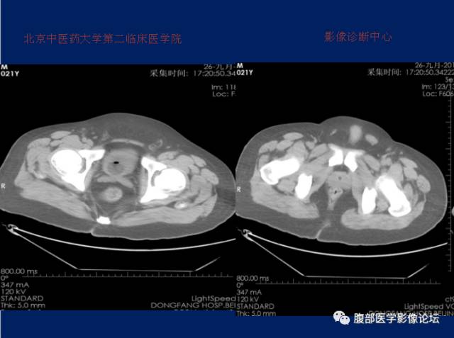 【病例】肝门静脉积气征1例CT影像表现 【病例】肝门静脉积气征1例CT影像表现