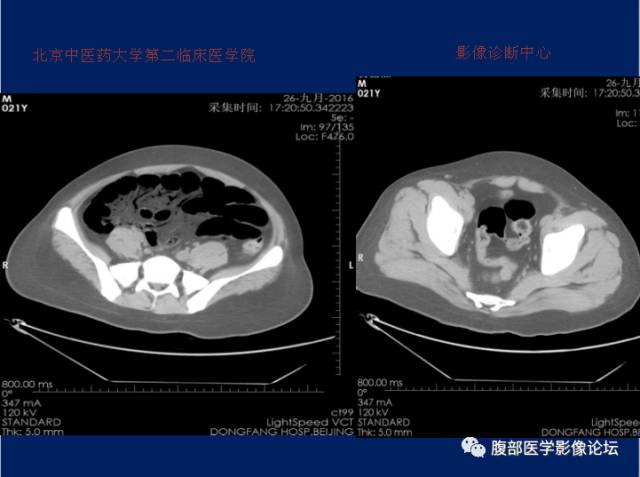 【病例】肝门静脉积气征1例CT影像表现 【病例】肝门静脉积气征1例CT影像表现