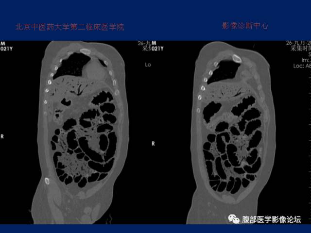 【病例】肝门静脉积气征1例CT影像表现 【病例】肝门静脉积气征1例CT影像表现