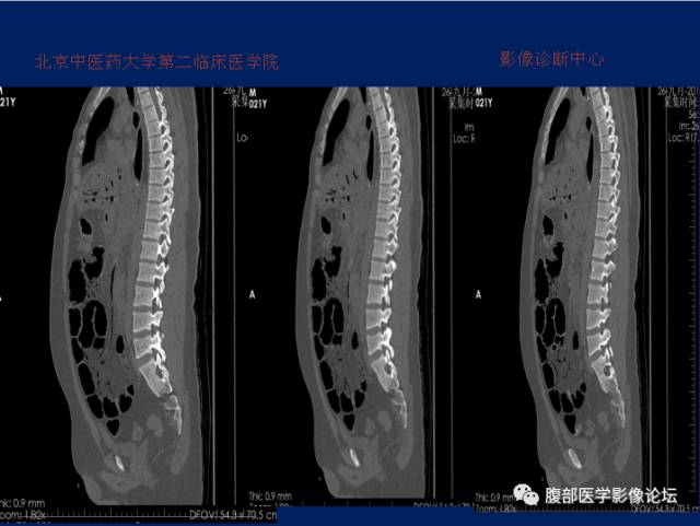 【病例】肝门静脉积气征1例CT影像表现 【病例】肝门静脉积气征1例CT影像表现