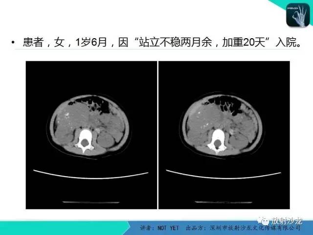 【病例】肾上腺节细胞神经瘤1例CT影像表现与鉴别