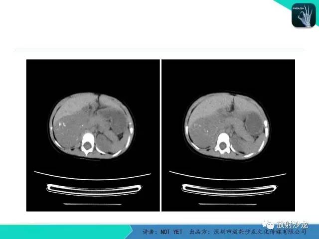 【病例】肾上腺节细胞神经瘤1例CT影像表现与鉴别