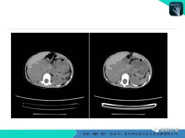 【病例】肾上腺节细胞神经瘤1例CT影像表现与鉴别