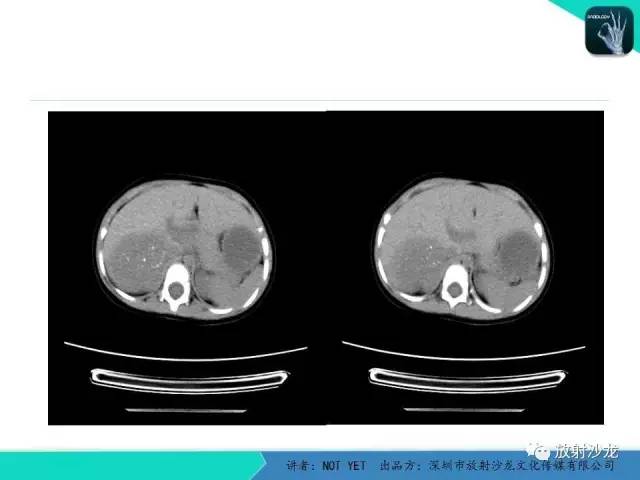 【病例】肾上腺节细胞神经瘤1例CT影像表现与鉴别