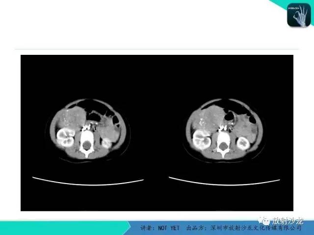 【病例】肾上腺节细胞神经瘤1例CT影像表现与鉴别