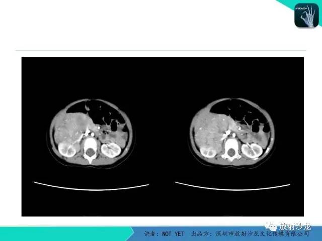 【病例】肾上腺节细胞神经瘤1例CT影像表现与鉴别