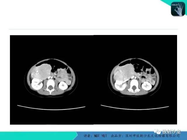 【病例】肾上腺节细胞神经瘤1例CT影像表现与鉴别