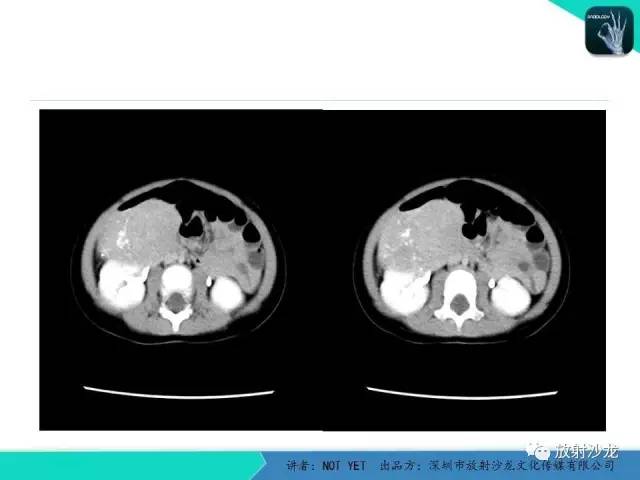 【病例】肾上腺节细胞神经瘤1例CT影像表现与鉴别