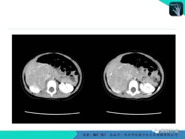 【病例】肾上腺节细胞神经瘤1例CT影像表现与鉴别