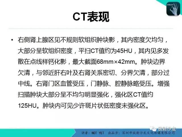 【病例】肾上腺节细胞神经瘤1例CT影像表现与鉴别