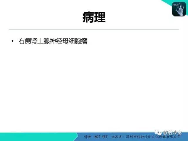 【病例】肾上腺节细胞神经瘤1例CT影像表现与鉴别