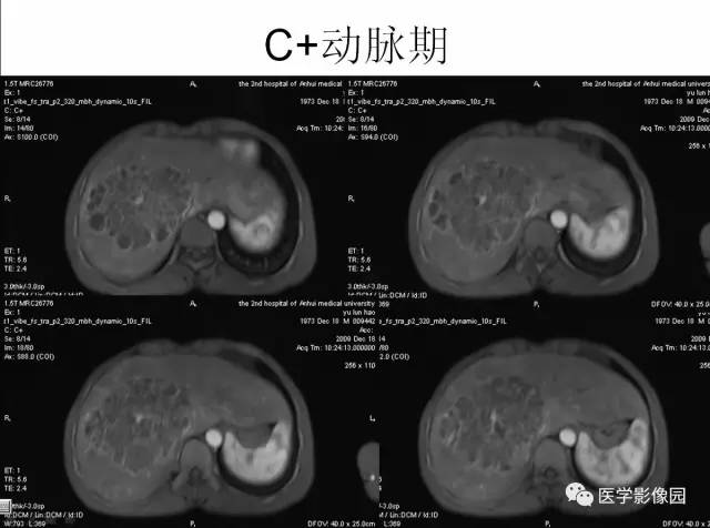 【病例】多房性肝脓肿1例CT及MR影像表现 【病例】多房性肝脓肿1例CT及MR影像表现