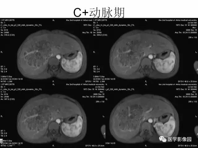 【病例】多房性肝脓肿1例CT及MR影像表现 【病例】多房性肝脓肿1例CT及MR影像表现
