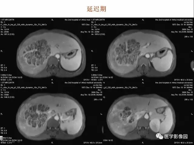 【病例】多房性肝脓肿1例CT及MR影像表现 【病例】多房性肝脓肿1例CT及MR影像表现