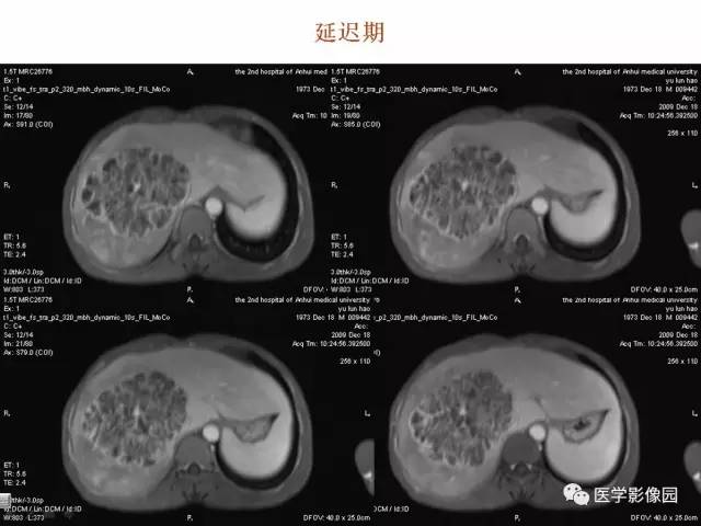 【病例】多房性肝脓肿1例CT及MR影像表现 【病例】多房性肝脓肿1例CT及MR影像表现