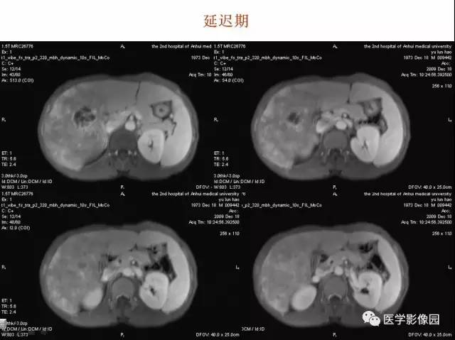 【病例】多房性肝脓肿1例CT及MR影像表现 【病例】多房性肝脓肿1例CT及MR影像表现