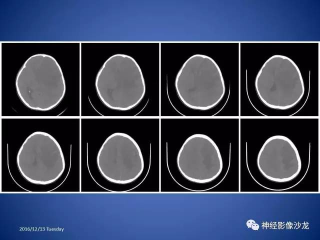 【病例】不典型脑膜瘤1例CT及MR影像讨论 【病例】不典型脑膜瘤1例CT及MR影像讨论