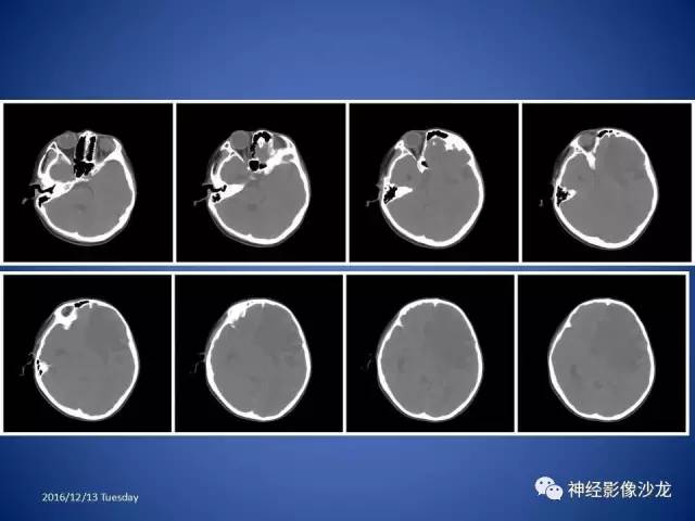 【病例】不典型脑膜瘤1例CT及MR影像讨论 【病例】不典型脑膜瘤1例CT及MR影像讨论