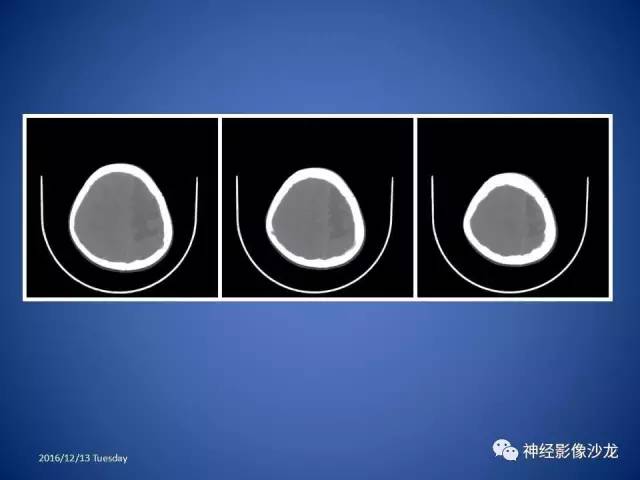 【病例】不典型脑膜瘤1例CT及MR影像讨论 【病例】不典型脑膜瘤1例CT及MR影像讨论