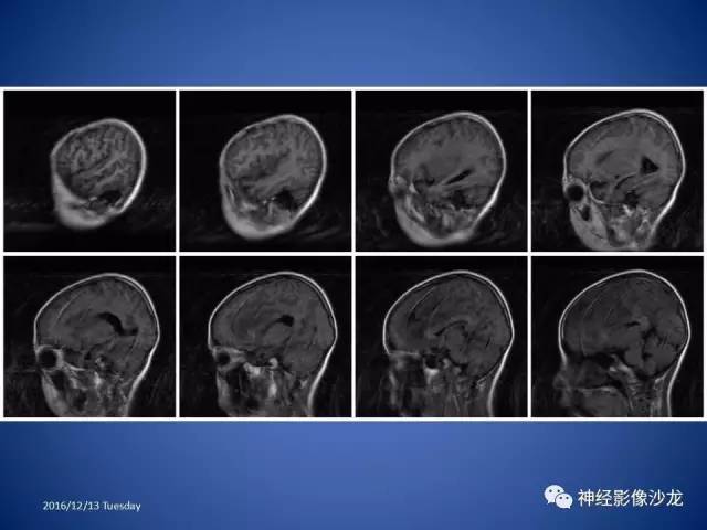 【病例】不典型脑膜瘤1例CT及MR影像讨论 【病例】不典型脑膜瘤1例CT及MR影像讨论