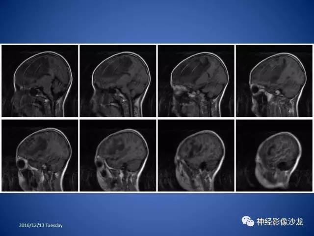 【病例】不典型脑膜瘤1例CT及MR影像讨论 【病例】不典型脑膜瘤1例CT及MR影像讨论