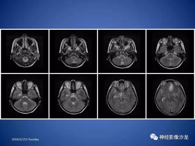 【病例】不典型脑膜瘤1例CT及MR影像讨论 【病例】不典型脑膜瘤1例CT及MR影像讨论