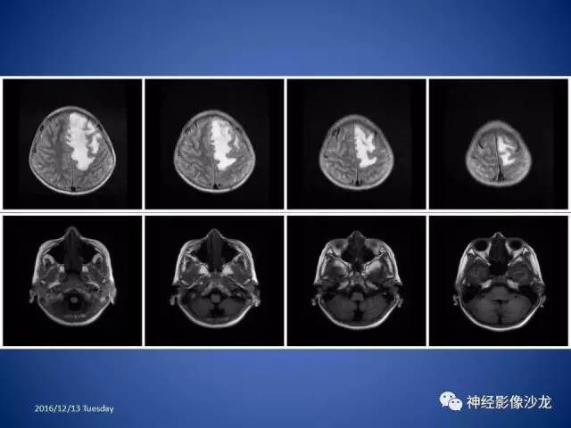 【病例】不典型脑膜瘤1例CT及MR影像讨论 【病例】不典型脑膜瘤1例CT及MR影像讨论