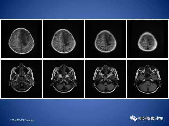 【病例】不典型脑膜瘤1例CT及MR影像讨论 【病例】不典型脑膜瘤1例CT及MR影像讨论
