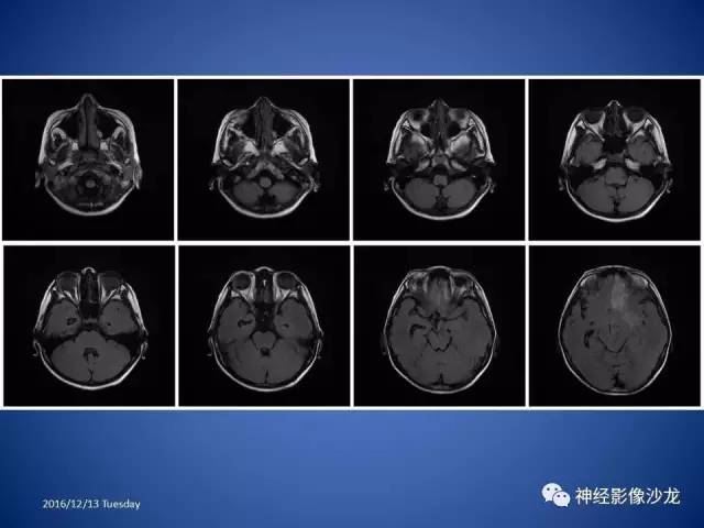 【病例】不典型脑膜瘤1例CT及MR影像讨论 【病例】不典型脑膜瘤1例CT及MR影像讨论