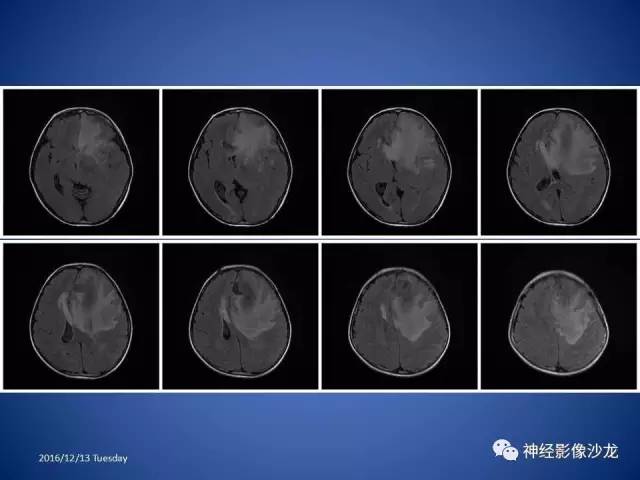 【病例】不典型脑膜瘤1例CT及MR影像讨论 【病例】不典型脑膜瘤1例CT及MR影像讨论