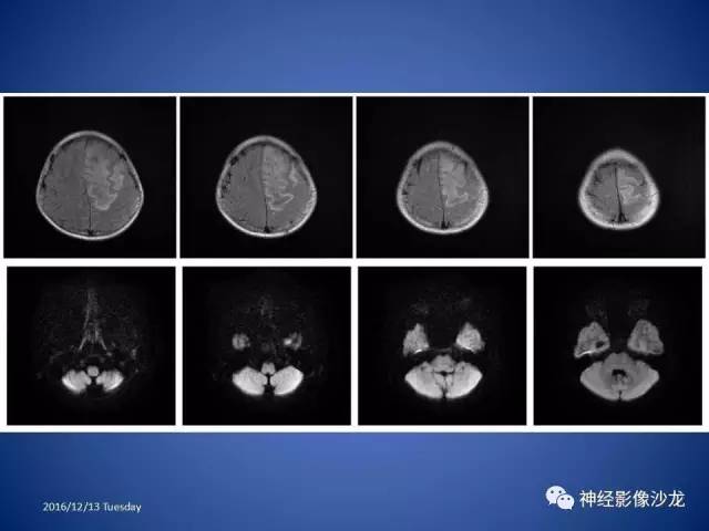 【病例】不典型脑膜瘤1例CT及MR影像讨论 【病例】不典型脑膜瘤1例CT及MR影像讨论