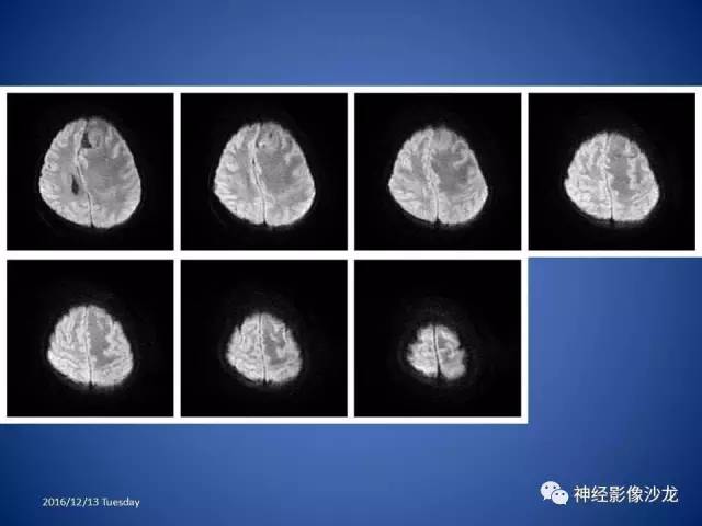 【病例】不典型脑膜瘤1例CT及MR影像讨论 【病例】不典型脑膜瘤1例CT及MR影像讨论