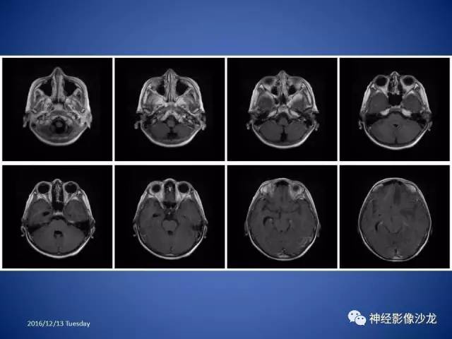 【病例】不典型脑膜瘤1例CT及MR影像讨论 【病例】不典型脑膜瘤1例CT及MR影像讨论
