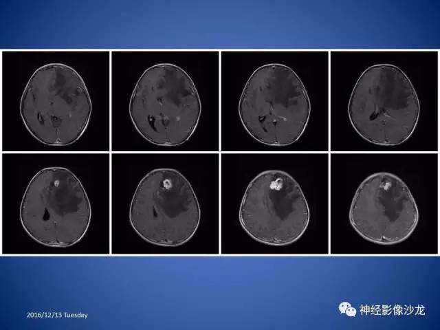 【病例】不典型脑膜瘤1例CT及MR影像讨论 【病例】不典型脑膜瘤1例CT及MR影像讨论