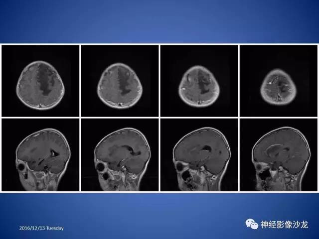 【病例】不典型脑膜瘤1例CT及MR影像讨论 【病例】不典型脑膜瘤1例CT及MR影像讨论