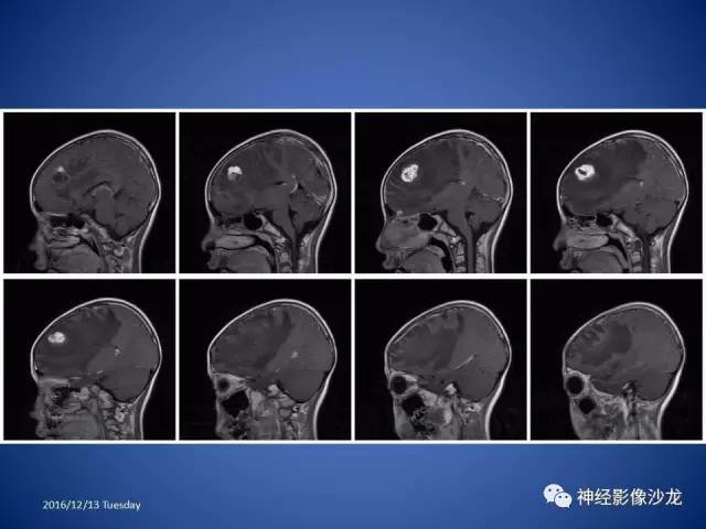 【病例】不典型脑膜瘤1例CT及MR影像讨论 【病例】不典型脑膜瘤1例CT及MR影像讨论