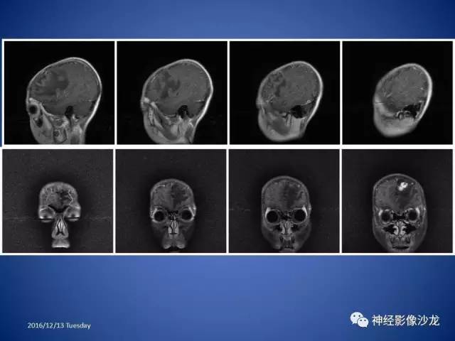 【病例】不典型脑膜瘤1例CT及MR影像讨论 【病例】不典型脑膜瘤1例CT及MR影像讨论